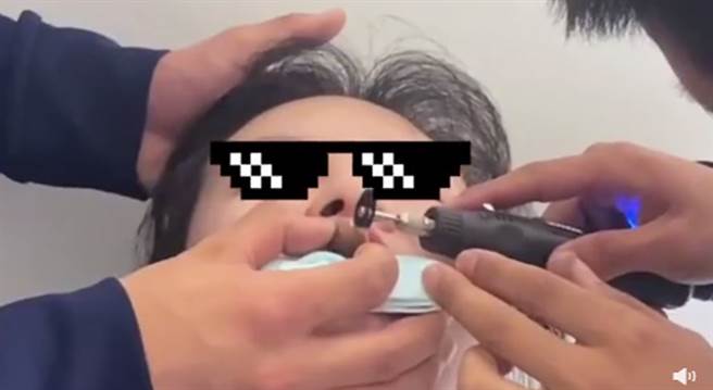 山东大妈吃田螺时，反被螺壳紧紧吸住上嘴唇，怎么拔都拔不下来。（图／翻摄自微博）