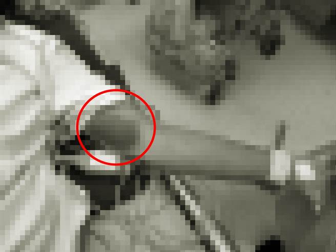 胡女被送到医院时已无呼吸心跳，红圈处可见左手臂内侧有大片圆形瘀青，高大成断言该为新伤。图片经变色与马赛克处理。（民眾提供）