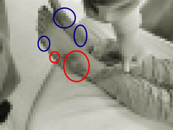 胡女的脚部也可见到新旧混杂的瘀伤，相当怵目。红圈为新伤，蓝圈为旧伤。图片经变色与马赛克处理。（民眾提供）