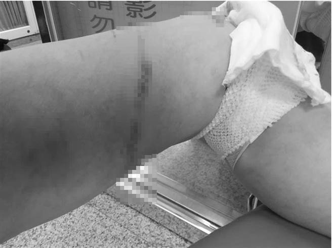 北市爆挖眼案 勸鄰居電梯戴口罩 婦人遭亂刀狂砍、抓臉戳眼。（翻攝爆料公社）
