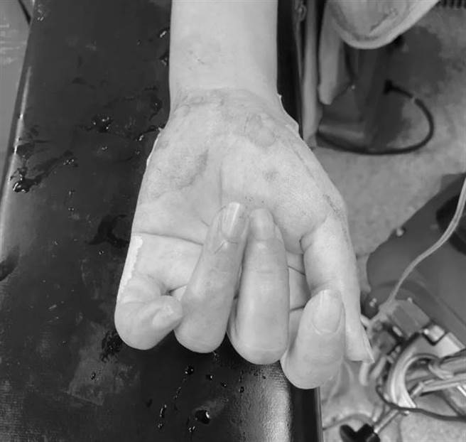 产妇生产过程中，整只手腕都沾染了血迹。（图／麻醉医师灵魂所在的地方）