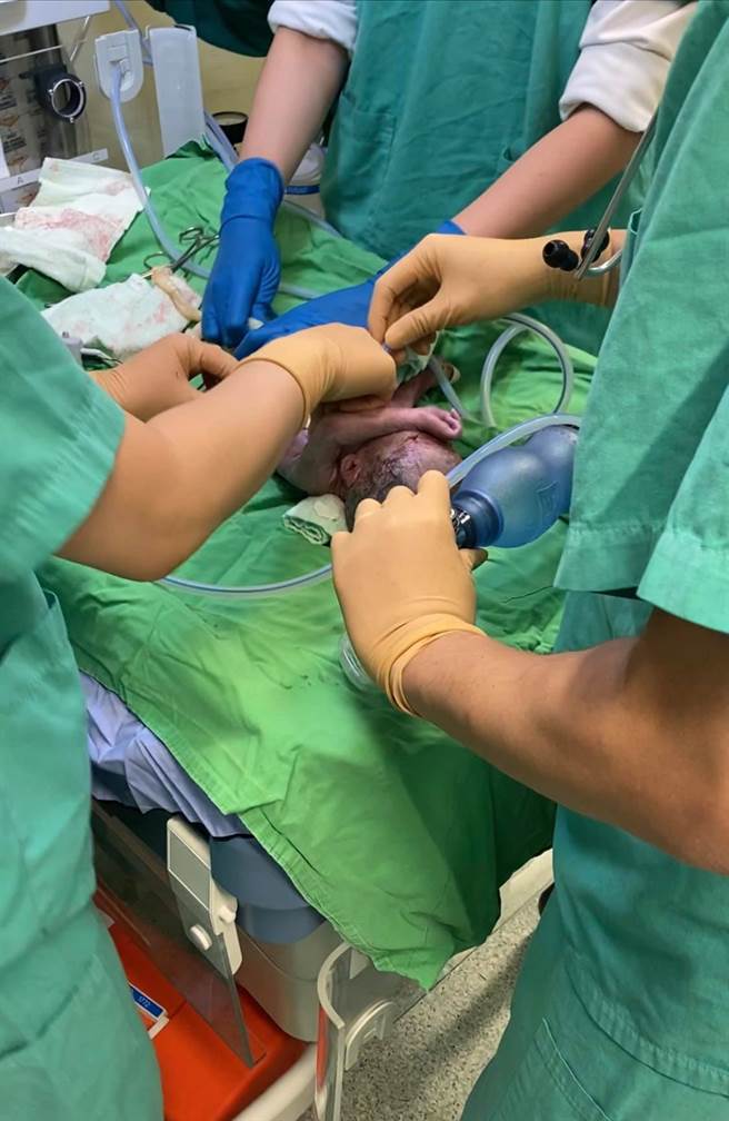 歷经一个多小时，终于将全身发紫的胎儿拉出来。（图／麻醉医师灵魂所在的地方）