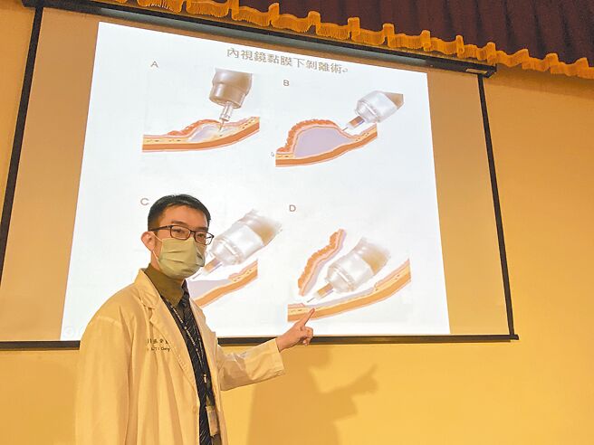 中国医药大学附设医院消化内科医师张安迪引进内视镜黏膜下肿瘤切除手术。（冯惠宜摄）