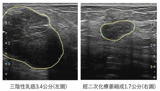 28岁未婚、三阴性乳癌患者在经两个疗程的化疗后，第八周后，发现她的乳癌肿瘤已从3.4公分缩小为1.7公分。（澄清医院提供／冯惠宜台中传真）