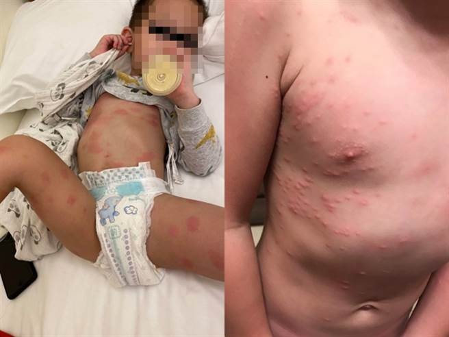 网友抱怨他日前带家人到垦丁1间民宿住宿，当晚全家人身上都冒出大面积红疹，而家人几乎都是躺在床上后才起疹，质疑是民宿清洁有问题。（翻摄自脸书「爆料公社二社」）