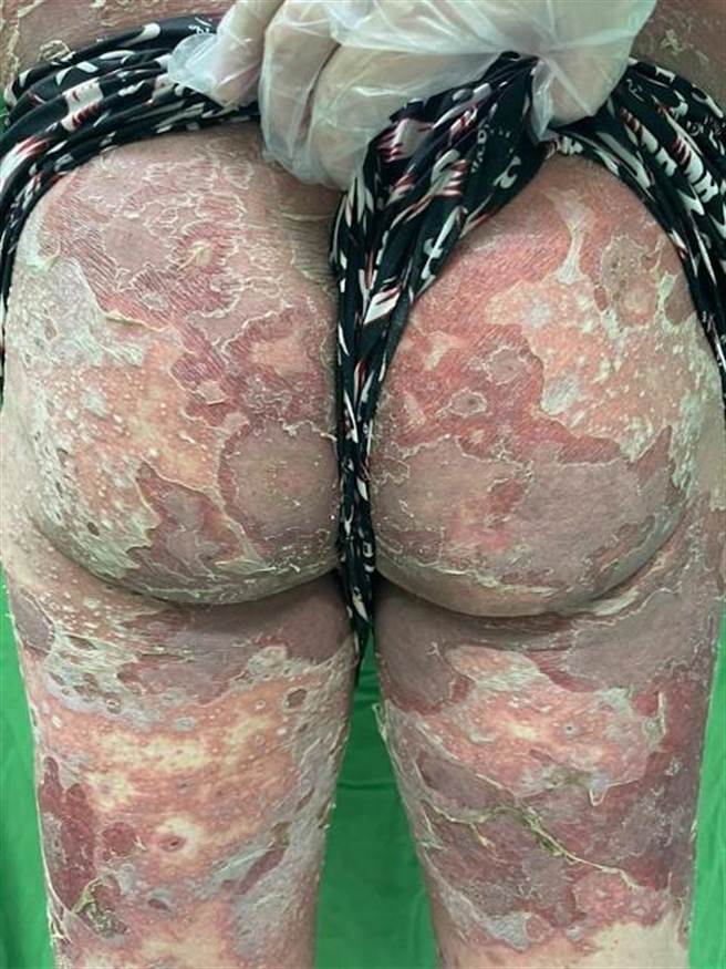 澎湖一名70岁老翁疑似打完疫苗全身出现性脓疱脱皮。（三总澎湖医院提供／陈可文传真）