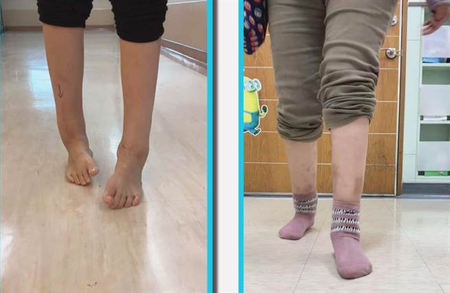 许老师至嘉基手术前双踝内翻变形（左），经切骨矫正手术后可正常行走（右）。（嘉基医院提供）