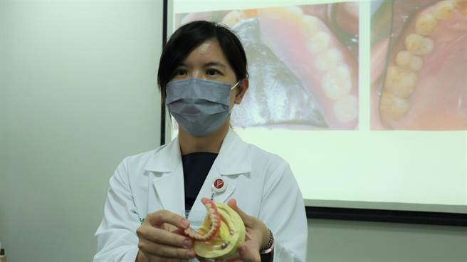 台南市柳营奇美医院口腔膺復科医师黄钰芬建议，对于远端缺牙较多的病人，若经济因素或是口腔条件不允许大范围植牙，可以考虑局部活动假牙加植牙。（张毓翎摄）