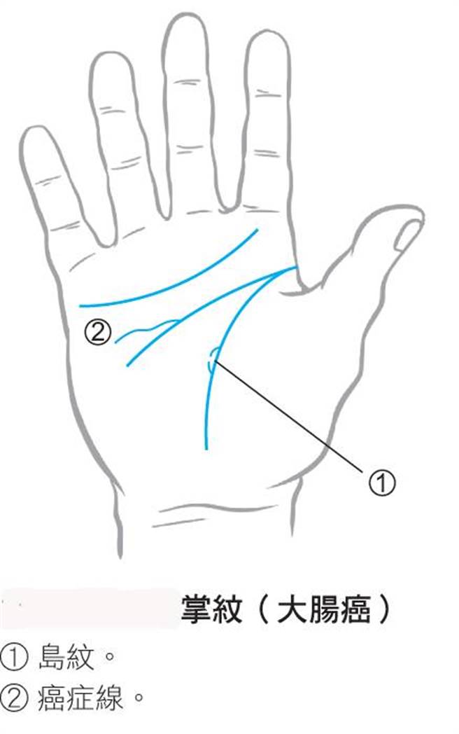 癌症掌纹特徵，是在手掌上出现癌症线和岛纹。(图/《算癌症》时报出版提供。仅供参考，个人疾病须以就医确诊为准。)