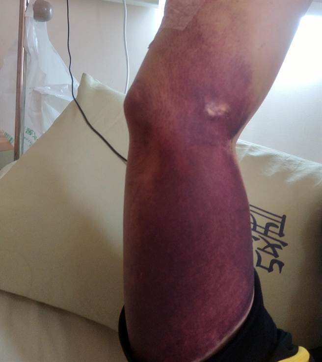 高雄一名男子打完BNT后全身出现血疹。（图／翻摄自爆料公社公开版）