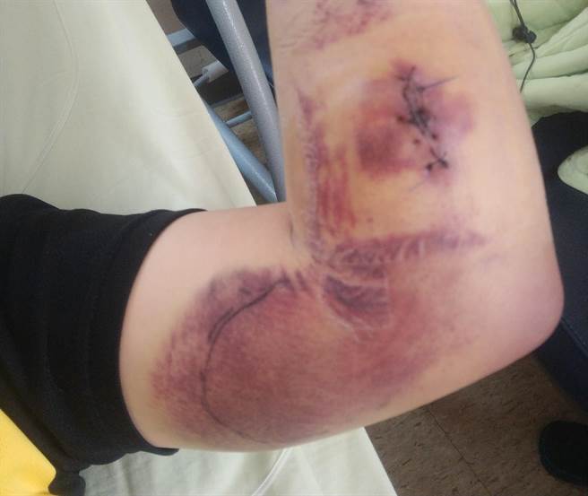 打BNT后出现全身血斑、牙龈出血和血便，高雄男紧急送医后惊呼「幸好不在脑和内臟」。（图／翻摄自爆料公社公开版）