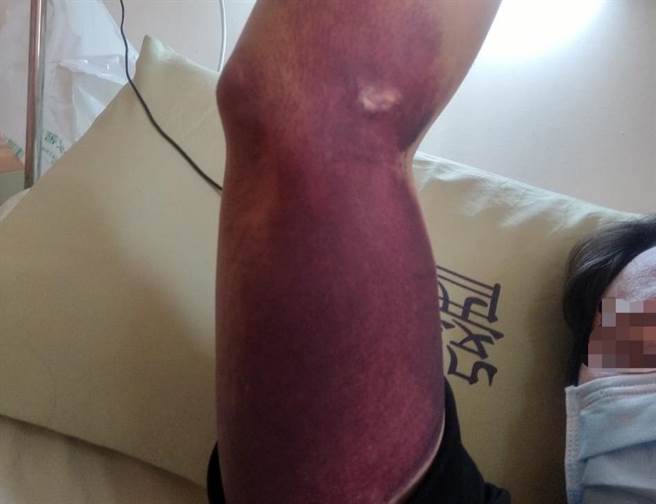 高雄林姓男子在脸书「爆料公社」社群发文，称自己日前接种BNT疫苗后，皮肤局部出现血疹，随后更有血便、牙龈出血等症状，紧急送医后，查出是血栓及血小板低下所引起。（摘自爆料公社脸书）