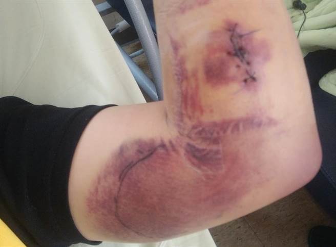 高雄林姓男子在脸书「爆料公社」社群发文，称自己日前接种BNT疫苗后，皮肤局部出现血疹，随后更有血便、牙龈出血等症状，紧急送医后，查出是血栓及血小板低下所引起。（摘自爆料公社脸书）