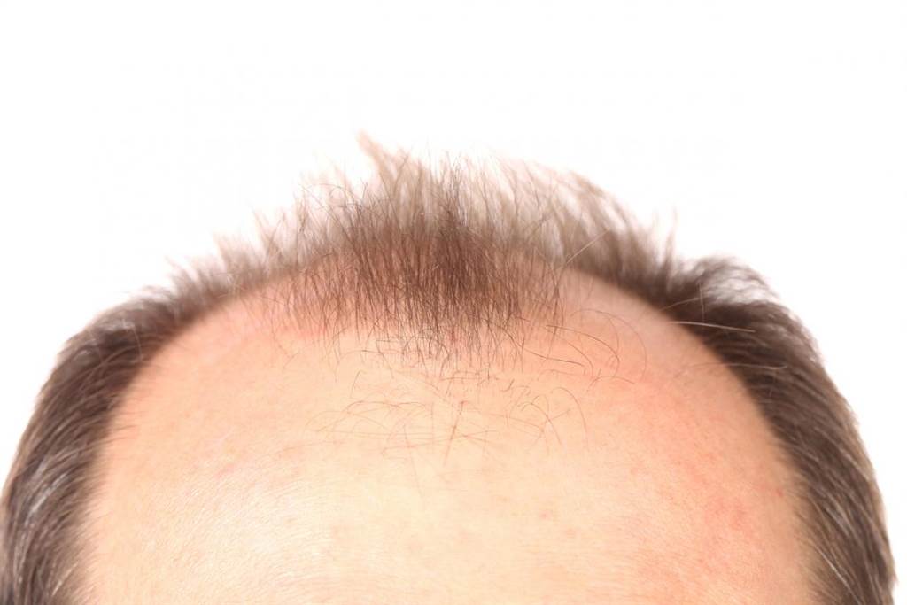 秃头不是病，但伤及尊严更要命。图/shutterstock(photo:ChinaTimes)