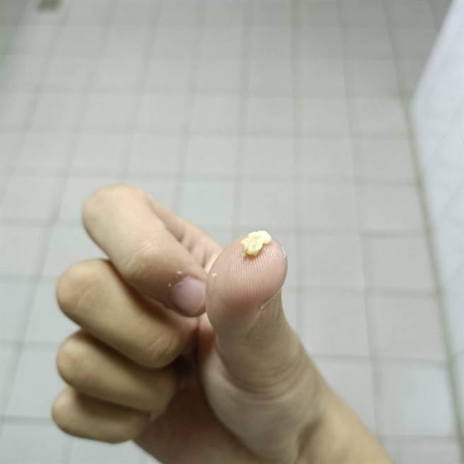 一名男大生日前觉得喉咙有异物，以为是菜渣，用力一咳竟咳出一大颗扁桃腺结石。(翻摄自Dcard)