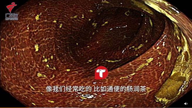 大腸黑病變又稱黑腸症，主要是因為長期服用「蒽醌類瀉藥」所引發。(圖/翻攝自廣東台觸電新聞)