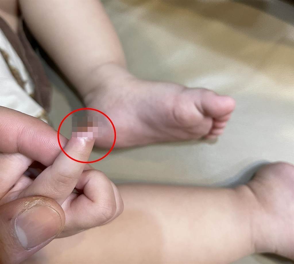 1歲7個月大女童遭保母剪掉右手食指的一角。（家長提供／曹婷婷台南傳真）