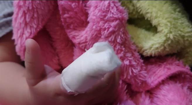 1歲7個月大女童遭保母剪掉右手食指的一角。（家長提供／曹婷婷台南傳真）
