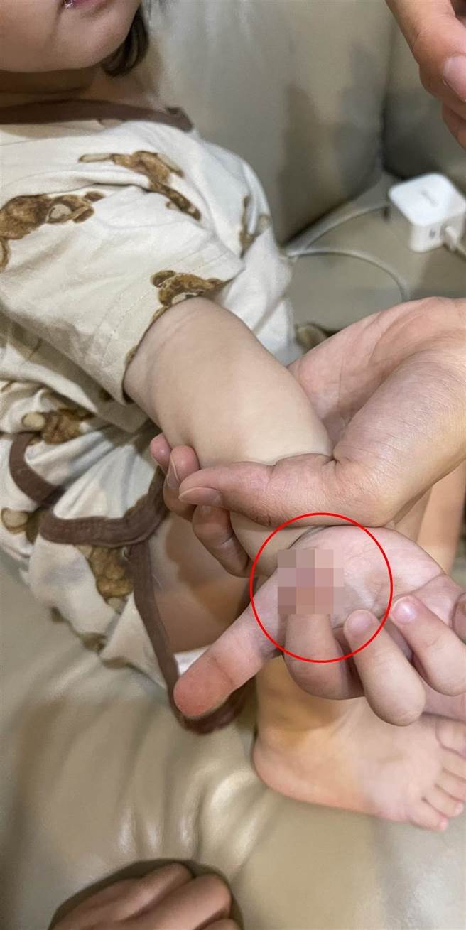 1歲7個月大女童遭保母剪掉右手食指的一角。（家長提供／曹婷婷台南傳真）