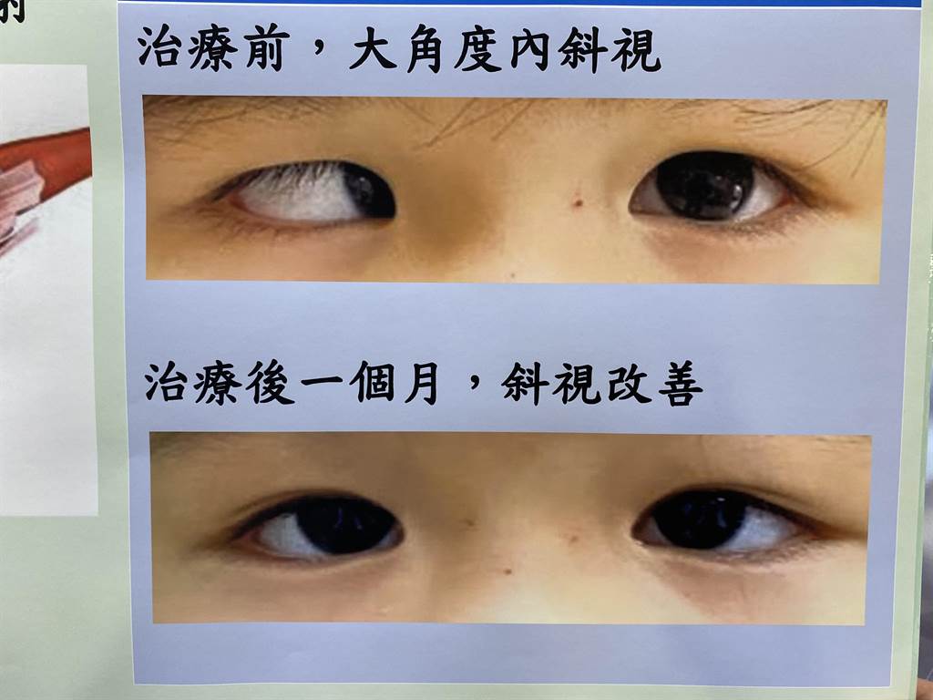 鬥雞眼」、「脫窗」眼部疾病喬好就變正妹- 健康- 中時