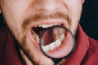口腔癌成因不只抽菸、嚼檳榔 長期戴假牙也是高危險群
