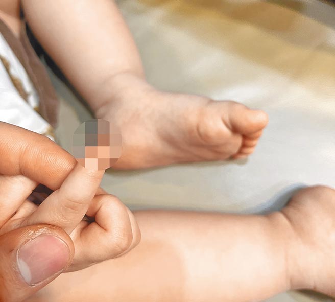 台南市1歲7個月大女童右手食指指尖，被保母拿剪刀剪麵時，剪掉1塊肉。（家長提供／曹婷婷台南傳真）