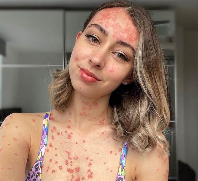 女子晒伤后，身体出现发痒的状况，隔了好几天，晒伤情形都未好转，之后才知罹患乾癣。(图翻摄自IG/claire_spurgin)