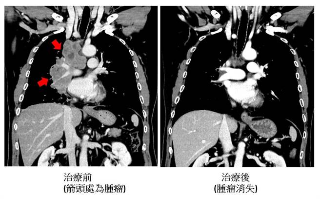 40年老菸枪接受化学治疗同时合併免疫治疗，他在化学治疗疗程结束后亦继续接受免疫治疗，现已持续超过一年半，后续追踪发现肺肿瘤几乎全消失。（澄清医院提供／冯惠宜台中传真）