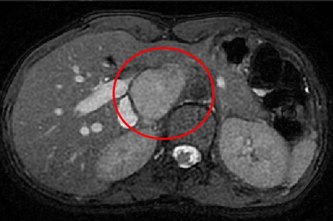 病人肝臟核磁共振檢查影像，圈起來的位置是腫瘤。（台中慈濟醫院提供／陳淑娥台中傳真）