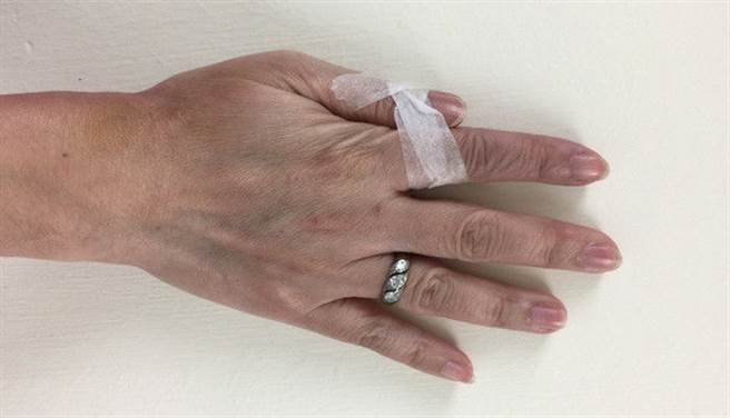 媽媽手症狀發作時要多休息，也可以使用護具，避免使用到拇指。(圖片來源：蔡曜鍵、康健雜誌提供)