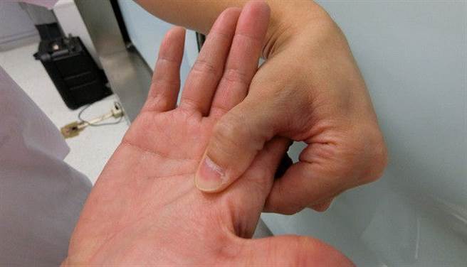 扳機指急性期時，可以針對痛點加壓。(圖片來源：康健雜誌提供)