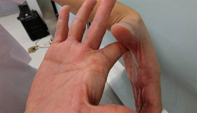 扳機指在緩解期時，可以做一些按摩、運動，類似扳手指的動作，拉扯肌腱。(圖片來源：康健雜誌提供)