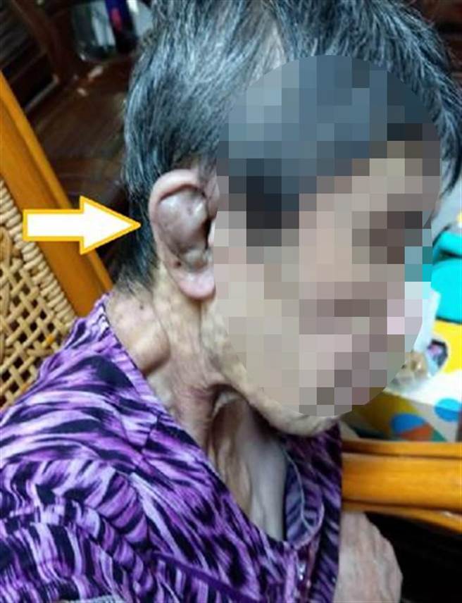 曹先生2019年4月透过仲介公司请来Lina照顾母亲，隔年7月开始母亲频频受伤，Lina称母亲在浴室跌倒额头缝针，耳朵也莫名出现积血肿胀。（家属提供／吴建辉彰化传真）