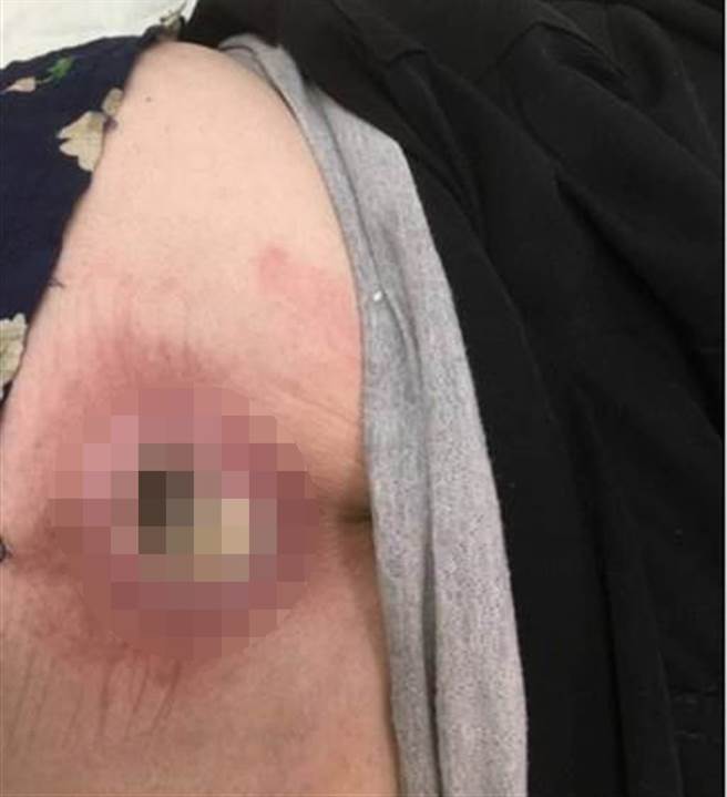 老妇腰部出现5公分深的褥疮。（家属提供／吴建辉彰化传真）