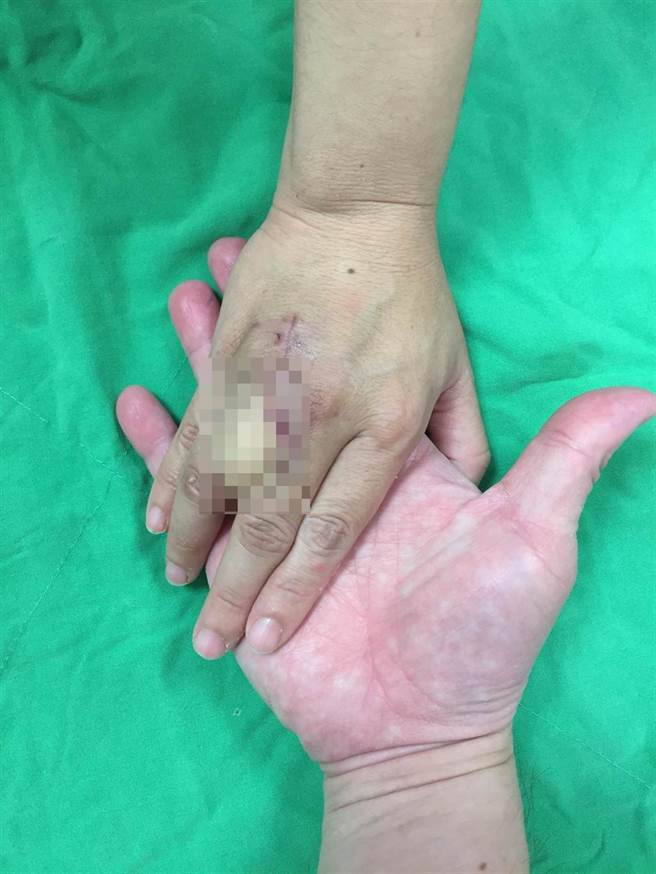 陈姓患者的手部遭车床贯穿，破了个洞，医疗团队採用「以皮补皮」方式治疗，保留其手部功能。（亚大医院提供／林欣仪台中传真）