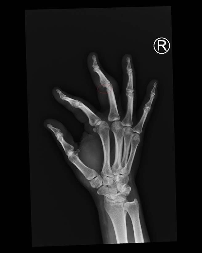 林妇右手X光片，中指关节骨头被侵蚀，缺了一小块。（院方提供／吴建辉彰化传真）