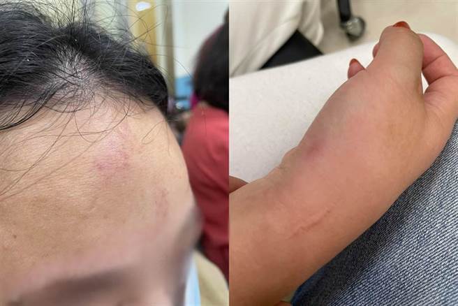 女子的丈夫在脸书社团爆料，称遭到微风南山专柜与警方的不合理对待，妻子被弄得一身伤。（翻摄爆料公社）
