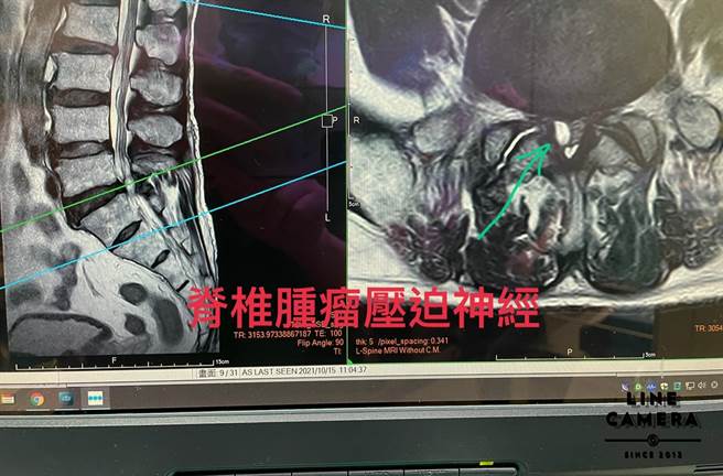 患者脊椎腫瘤壓迫神經。（豐原醫院提供／王文吉台中傳真）