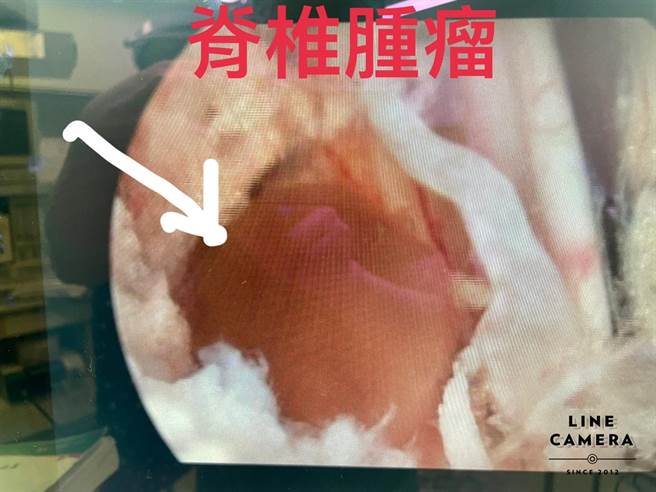 脊椎腫瘤。（豐原醫院提供／王文吉台中傳真）