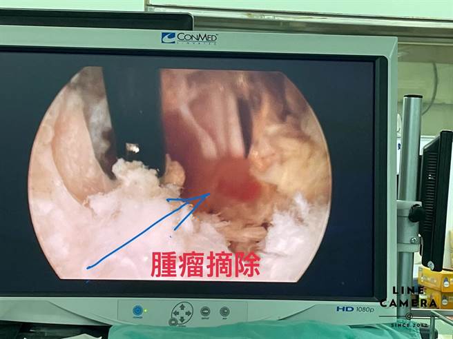 腫瘤摘除。（豐原醫院提供／王文吉台中傳真）