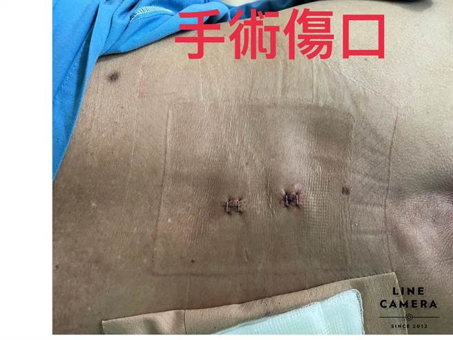 微創雙孔內視鏡手術後傷口。（豐原醫院提供／王文吉台中傳真）