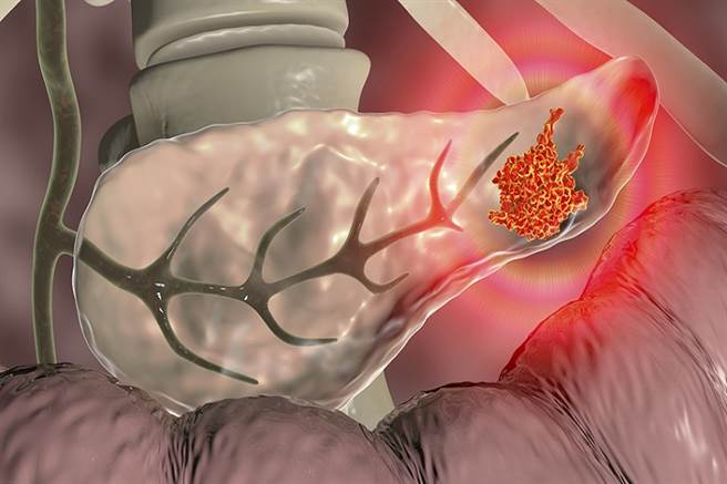 「癌王」胰臟癌7大高风险群 最易轻忽的共通点曝光！(示意图/Shutterstock)