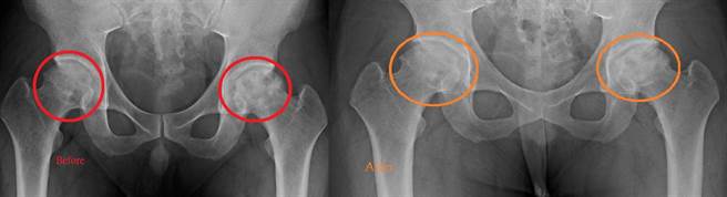 一位32岁从事服务业的男子双侧髋关节缺血性坏死，担心太年轻、进行人工髋关节置换术会有使用年限问题，尝试水介质震波治疗，没想到一个月后即有修復坏死组织的效果。（活力得中山脊椎外科医院提供／袁庭尧高雄传真）