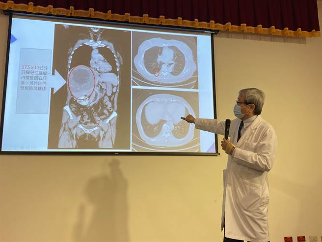 中国附医器官移植中心荣誉院长郑隆宾指出，蔡女士电脑断层检查发现右侧肝臟有一颗大到17.5x12公分的巨大肿瘤，而两侧肺部可见多颗小转移，临床诊断已经是第四期肝癌。（冯惠宜摄）