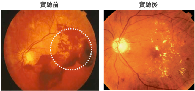 圖一、50歲，糖尿病患因視網膜病變出血而出現飛蚊症（眼底鏡）(圖/好食課提供)