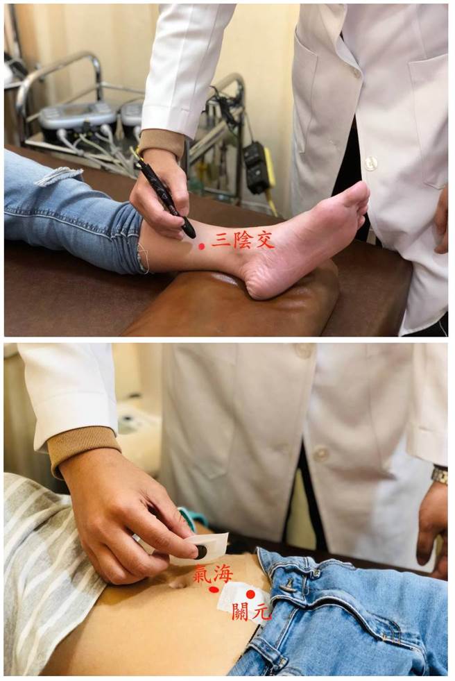 用雷射针灸三阴交穴位(图上)及在气海穴和关元穴热敷贴(图下)，能缩短尿床的病程。(图/谢雯麒、姜智钊中医师提供)