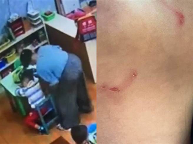 高雄1名幼稚园3岁女童疑似遭老师以「强灌」方式喂食感冒药，脖子出现多处抓痕伤口，高市教育局回应若属实将会开罚。（家属提供／洪浩轩高雄传真）