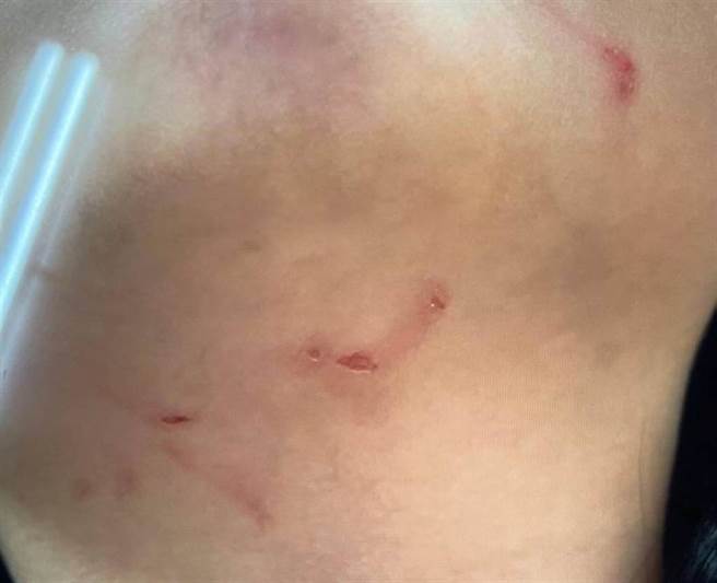 高雄1名幼稚园3岁女童疑似遭老师以「强灌」方式喂食感冒药，脖子出现多处抓痕伤口，高市教育局回应若属实将会开罚。（家属提供／洪浩轩高雄传真）