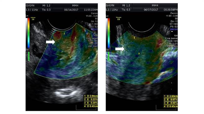 彩色超音波弹性成像技术，子宫颈闭锁不全的子宫颈在超音波下红色区域的比例增加(左)，一般族群的子宫颈在超音波下大部分为蓝色区域(右)。(图/台北马偕医院提供)