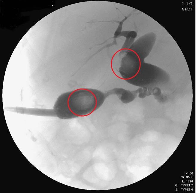 南投91岁阿嬷胆结石（红圈处），医师以皮穿肝体外取石术移除。（南投医院提供／廖志晃南投传真）